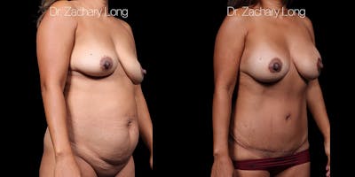 HiDefinition Liposuction Before & After Gallery - Patient 297161 - Image 2