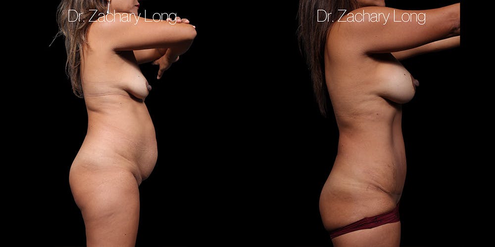 HiDefinition Liposuction Before & After Gallery - Patient 297161 - Image 3