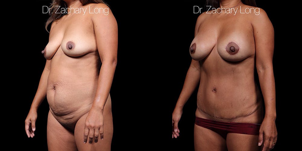 HiDefinition Liposuction Before & After Gallery - Patient 297161 - Image 4