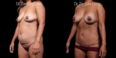 HiDefinition Liposuction Before & After Gallery - Patient 297161 - Image 4