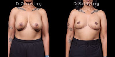 Breast Implant Removal Before & After Gallery - Patient 150341 - Image 1