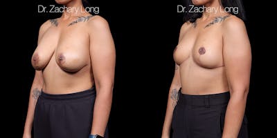 Breast Lift Before & After Gallery - Patient 132754 - Image 4