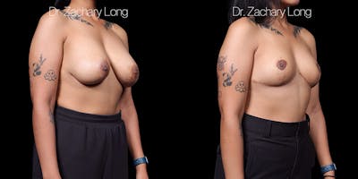 Breast Lift Before & After Gallery - Patient 132754 - Image 2