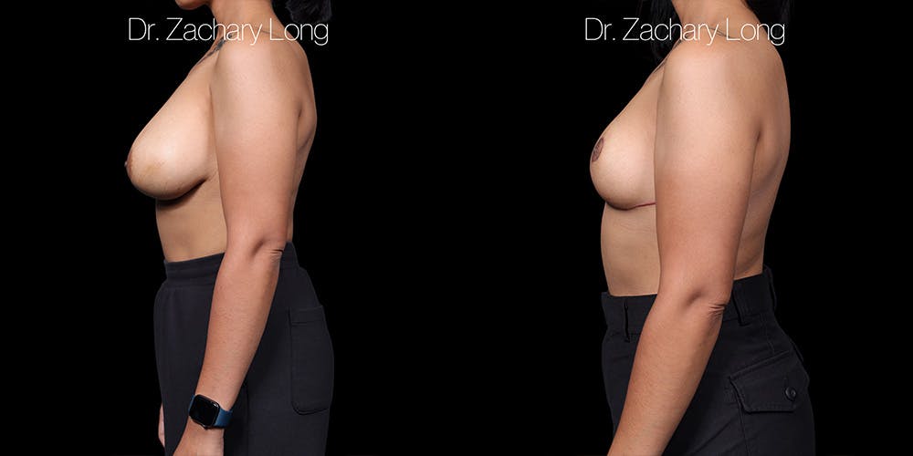 Breast Lift Before & After Gallery - Patient 132754 - Image 5