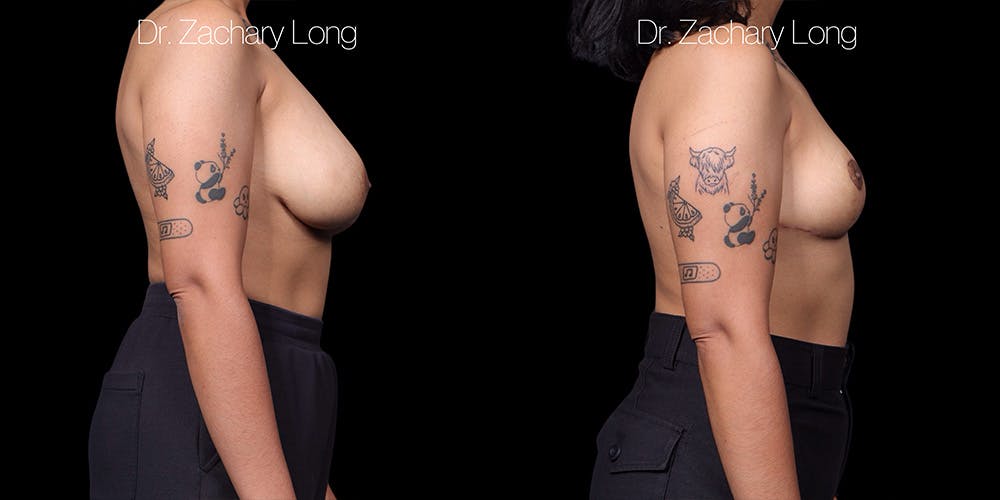 Breast Lift Before & After Gallery - Patient 132754 - Image 3