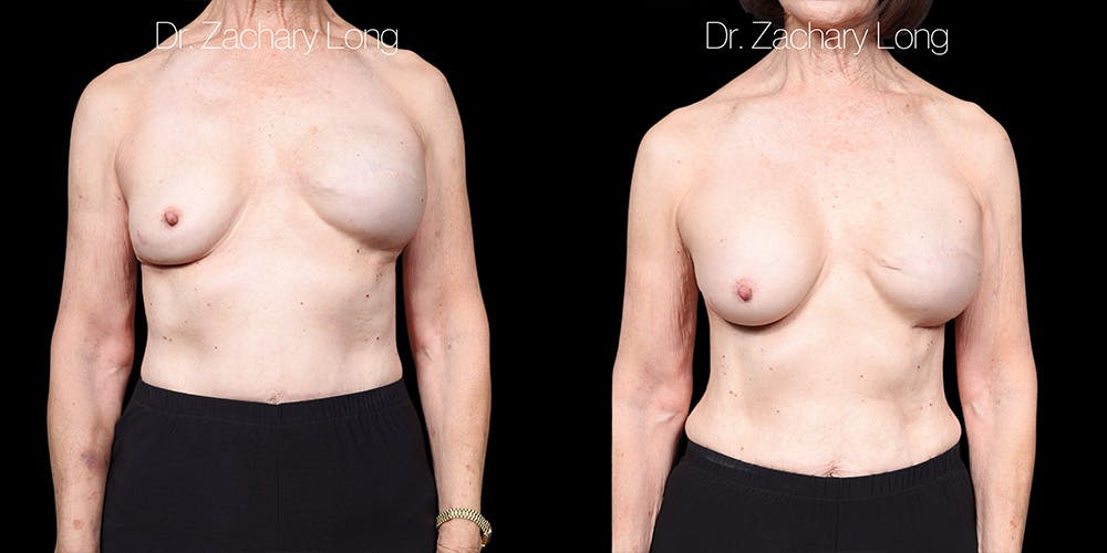 Breast Augmentation Revision Before & After Gallery - Patient 250957 - Image 1