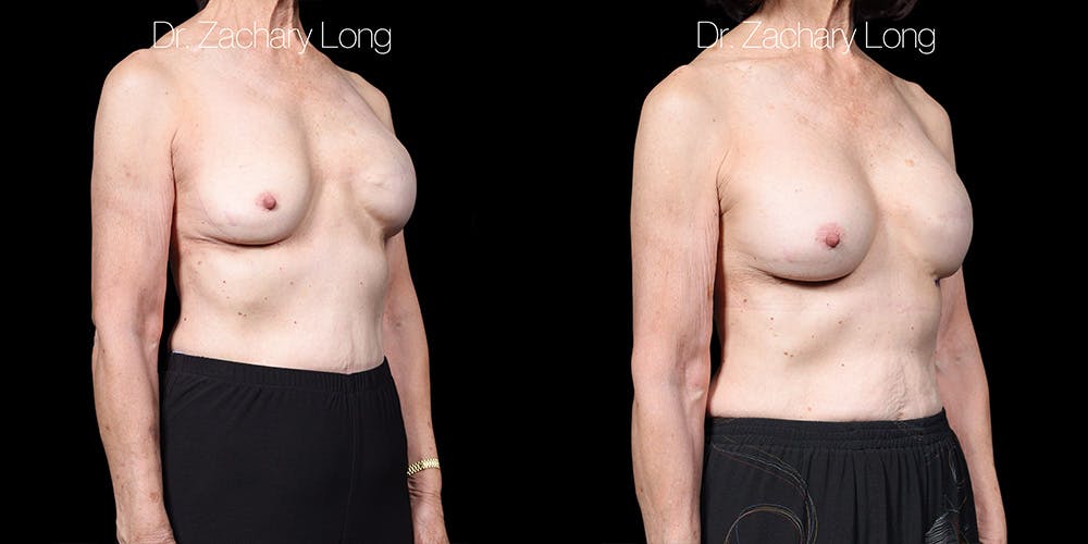 Breast Augmentation Revision Before & After Gallery - Patient 250957 - Image 2