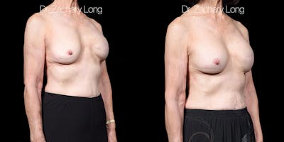 Breast Augmentation Revision Before & After Gallery - Patient 250957 - Image 2