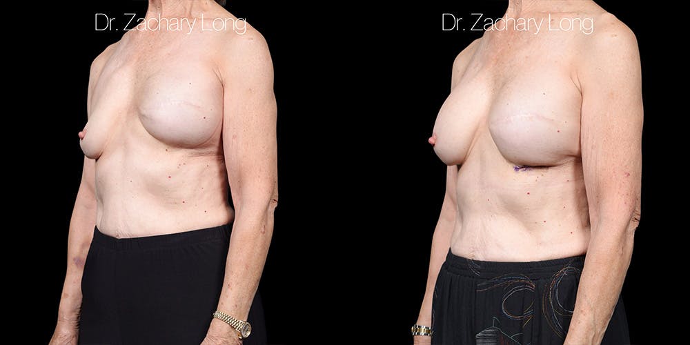 Breast Augmentation Revision Before & After Gallery - Patient 250957 - Image 3