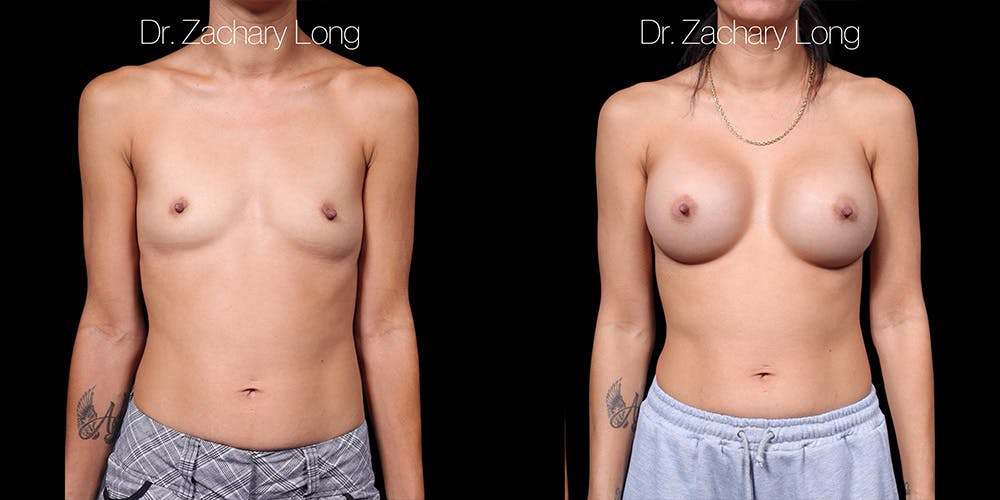 Breast Augmentation Before & After Gallery - Patient 178553 - Image 1
