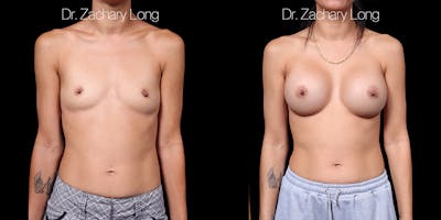 Breast Augmentation Before & After Gallery - Patient 178553 - Image 1