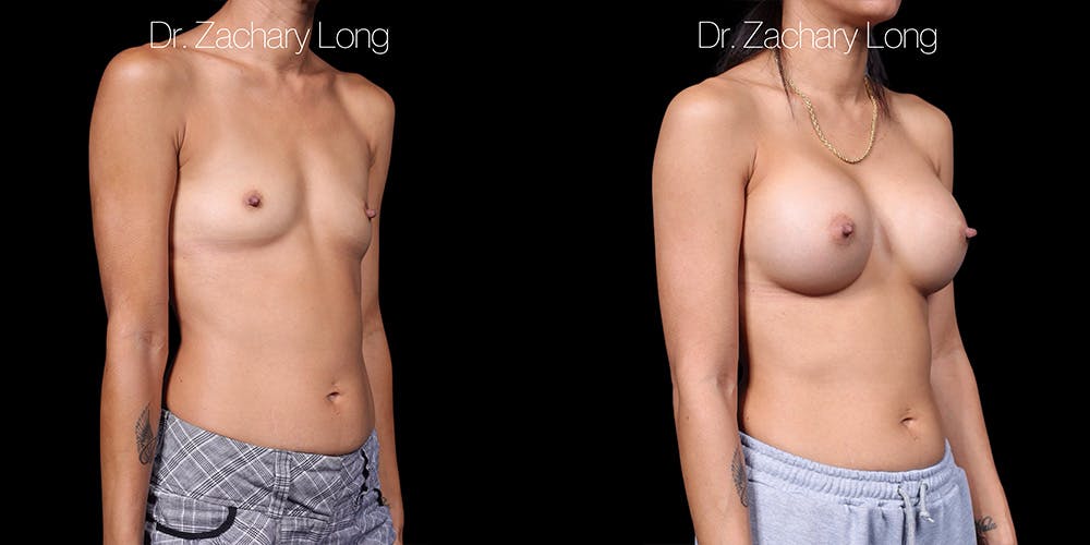 Breast Augmentation Before & After Gallery - Patient 178553 - Image 2