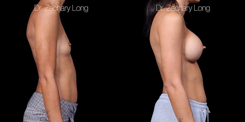 Breast Augmentation Before & After Gallery - Patient 178553 - Image 3