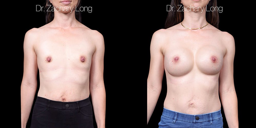 Breast Augmentation Before & After Gallery - Patient 347635 - Image 1