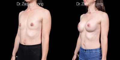 Breast Augmentation Before & After Gallery - Patient 347635 - Image 2