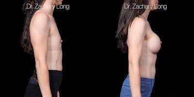Breast Augmentation Before & After Gallery - Patient 347635 - Image 4