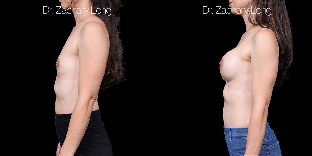 Breast Augmentation Before & After Gallery - Patient 347635 - Image 3