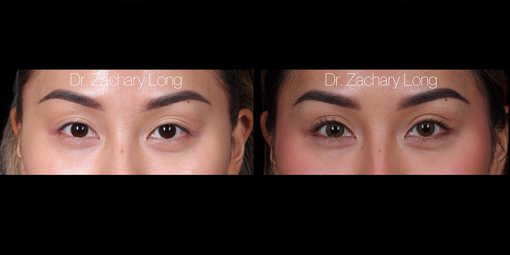 Eyelid Surgery Before & After Gallery - Patient 240822 - Image 1