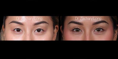 Eyelid Surgery Before & After Gallery - Patient 240822 - Image 1