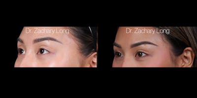 Eyelid Surgery Before & After Gallery - Patient 240822 - Image 2
