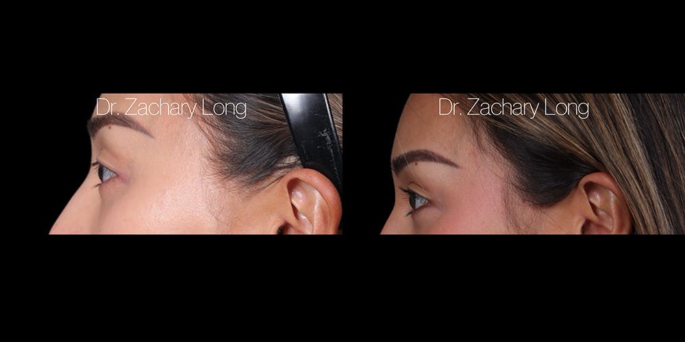 Eyelid Surgery Before & After Gallery - Patient 240822 - Image 3
