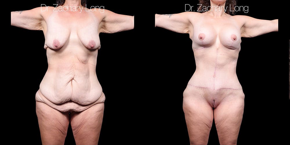 Breast Augmentation Before & After Gallery - Patient 240433 - Image 1