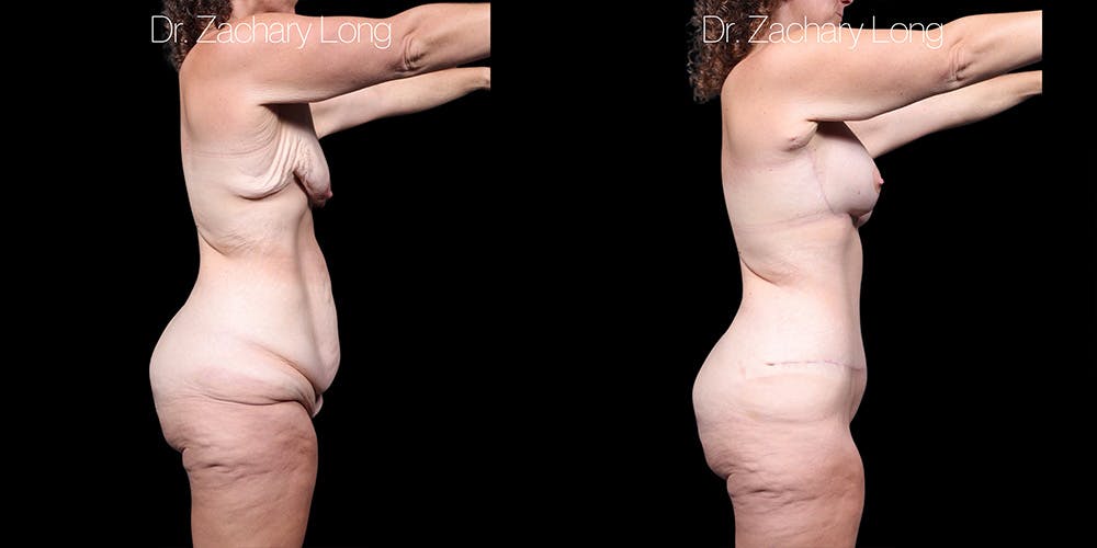 Breast Augmentation Before & After Gallery - Patient 240433 - Image 3