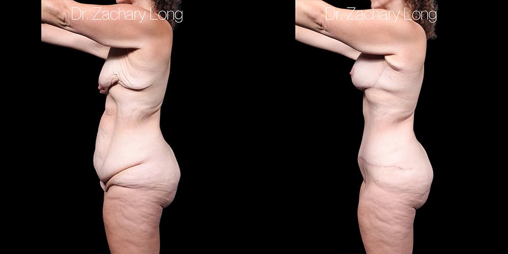 Breast Augmentation Before & After Gallery - Patient 240433 - Image 5