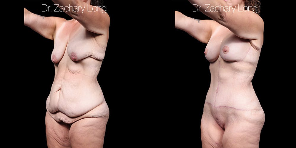 Breast Augmentation Before & After Gallery - Patient 240433 - Image 4