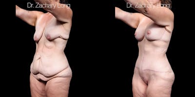 Breast Augmentation Before & After Gallery - Patient 240433 - Image 4