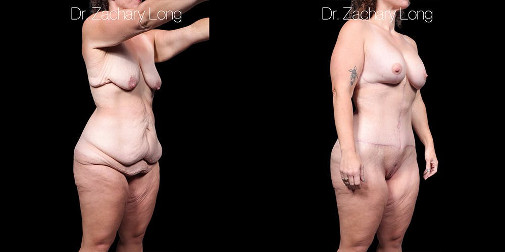 Breast Augmentation Before & After Gallery - Patient 240433 - Image 2