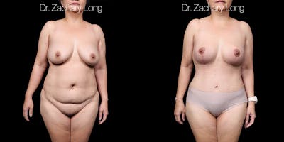 Breast Augmentation Before & After Gallery - Patient 118245 - Image 1