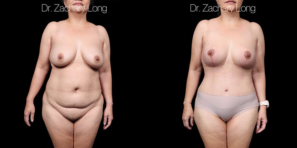 Breast Augmentation Before & After Gallery - Patient 118245 - Image 1