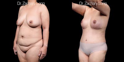 Breast Augmentation Before & After Gallery - Patient 118245 - Image 4