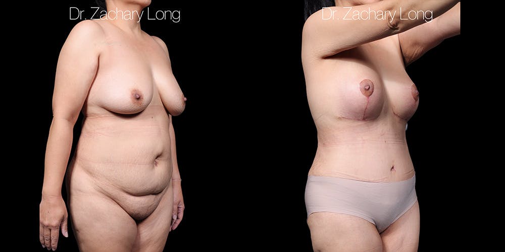 Breast Augmentation Before & After Gallery - Patient 118245 - Image 2
