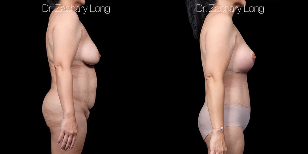 Breast Augmentation Before & After Gallery - Patient 118245 - Image 3