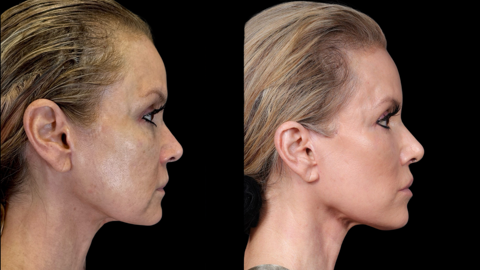 The Ascend Lift represents the best of natural rejuvenation. My patient above shows no visible signs of surgery. She looks rested, youthful, and natural. To her, she was reborn. To her friends and family, she looks happier and healthier.