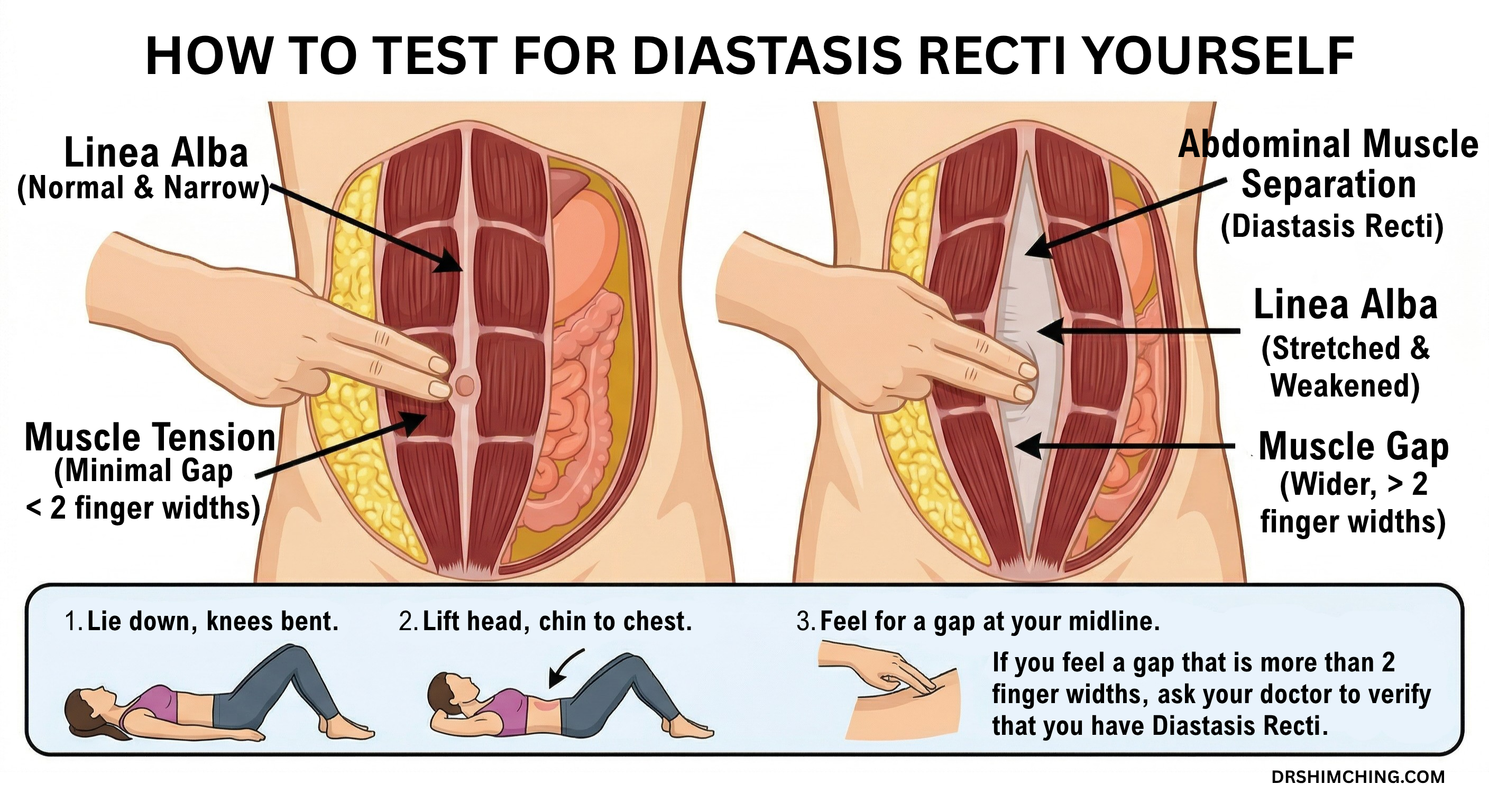 A simple at-home self-check for diastasis recti.