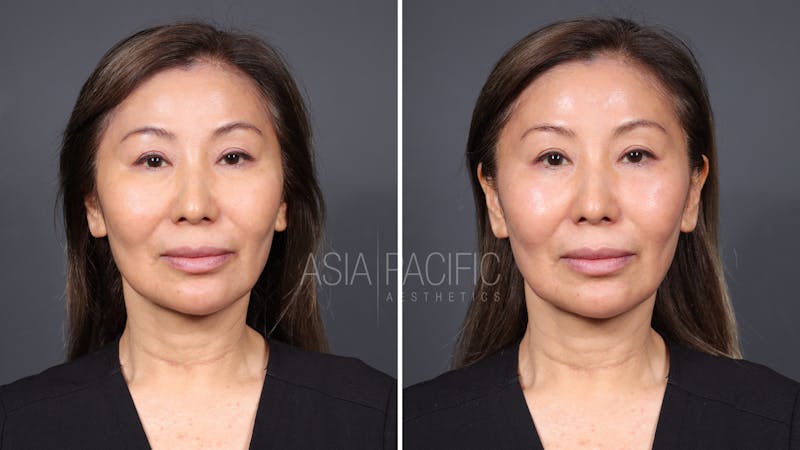 Patient before and after XERF Laser Treatment