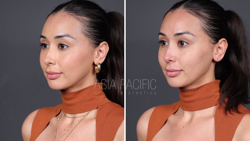 Patient before and after XERF Laser Treatment