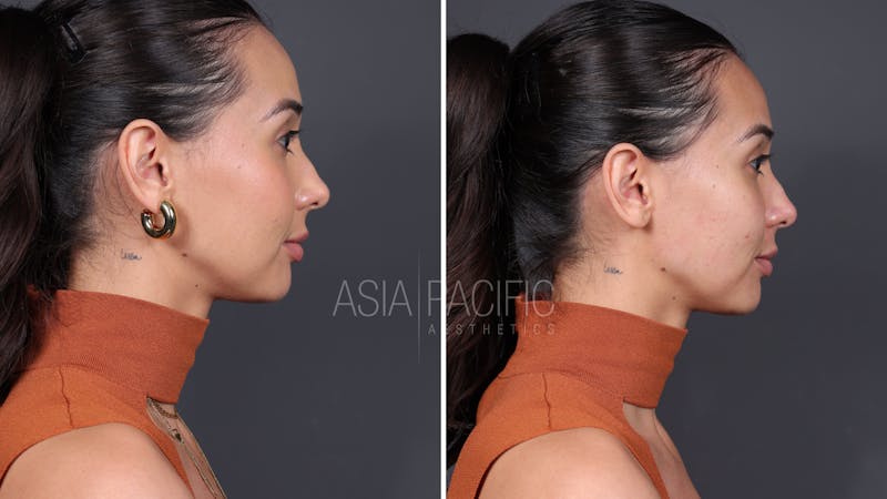 Patient before and after XERF Laser Treatment