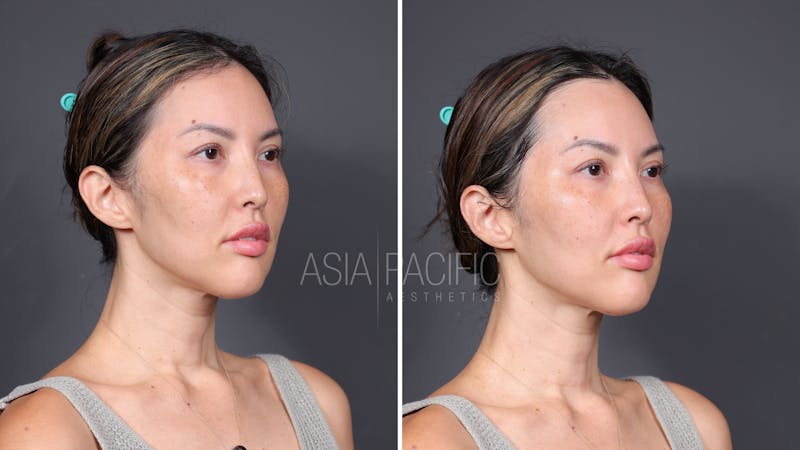 Patient before and after XERF Laser Treatment