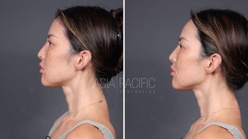 Patient before and after XERF Laser Treatment