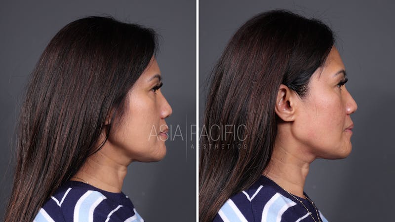 Patient before and after XERF Laser Treatment