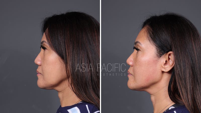 Patient before and after XERF Laser Treatment