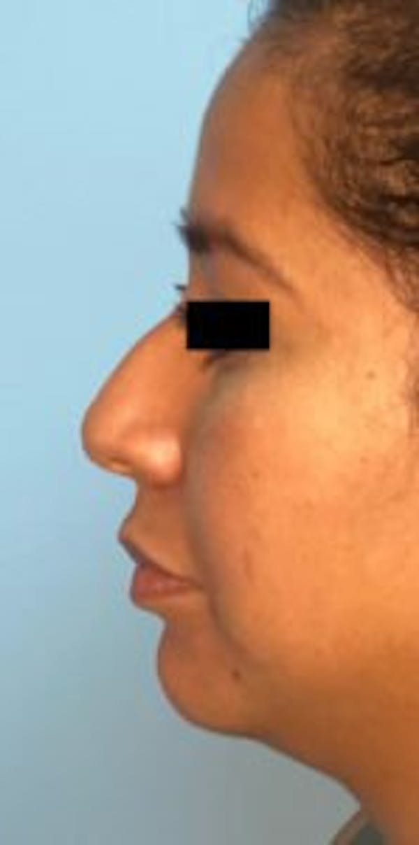Non-Surgical Rhinoplasty Gallery - Patient 33513102 - Image 1