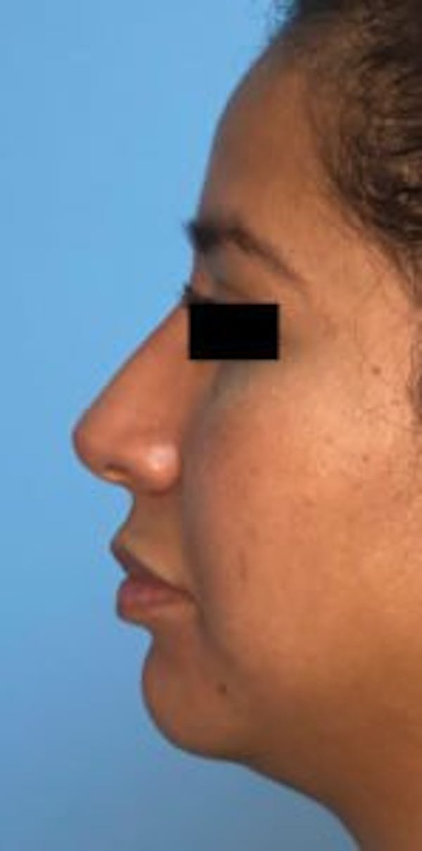 Non-Surgical Rhinoplasty Before & After Gallery - Patient 33513102 - Image 2