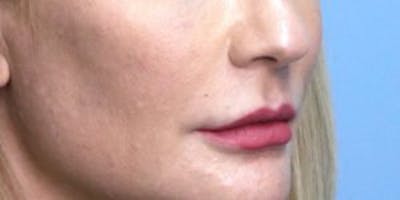 Lip Lift Before & After Gallery - Patient 33513134 - Image 1