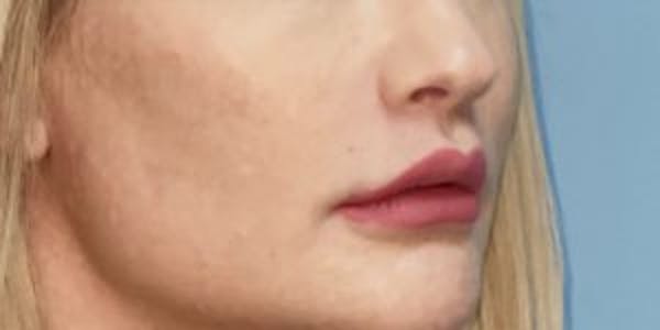 Lip Lift Before & After Gallery - Patient 33513134 - Image 2