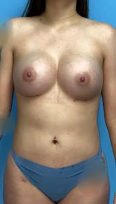 Breast Augmentation Before & After Gallery - Patient 33513194 - Image 2